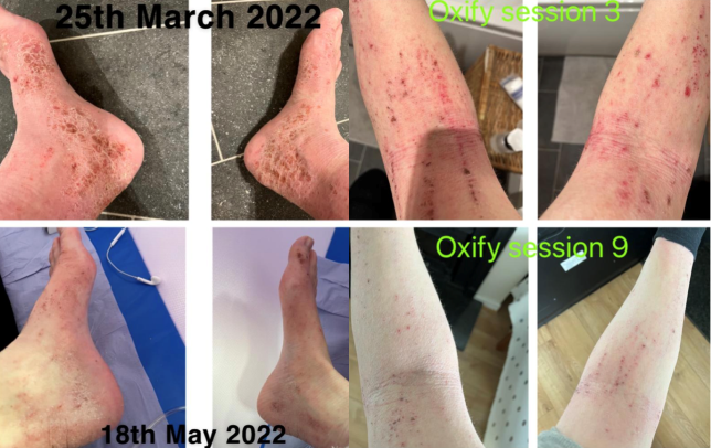 Hyperbaric Oxygen Therapy may be the secret cure to treat Topical ...